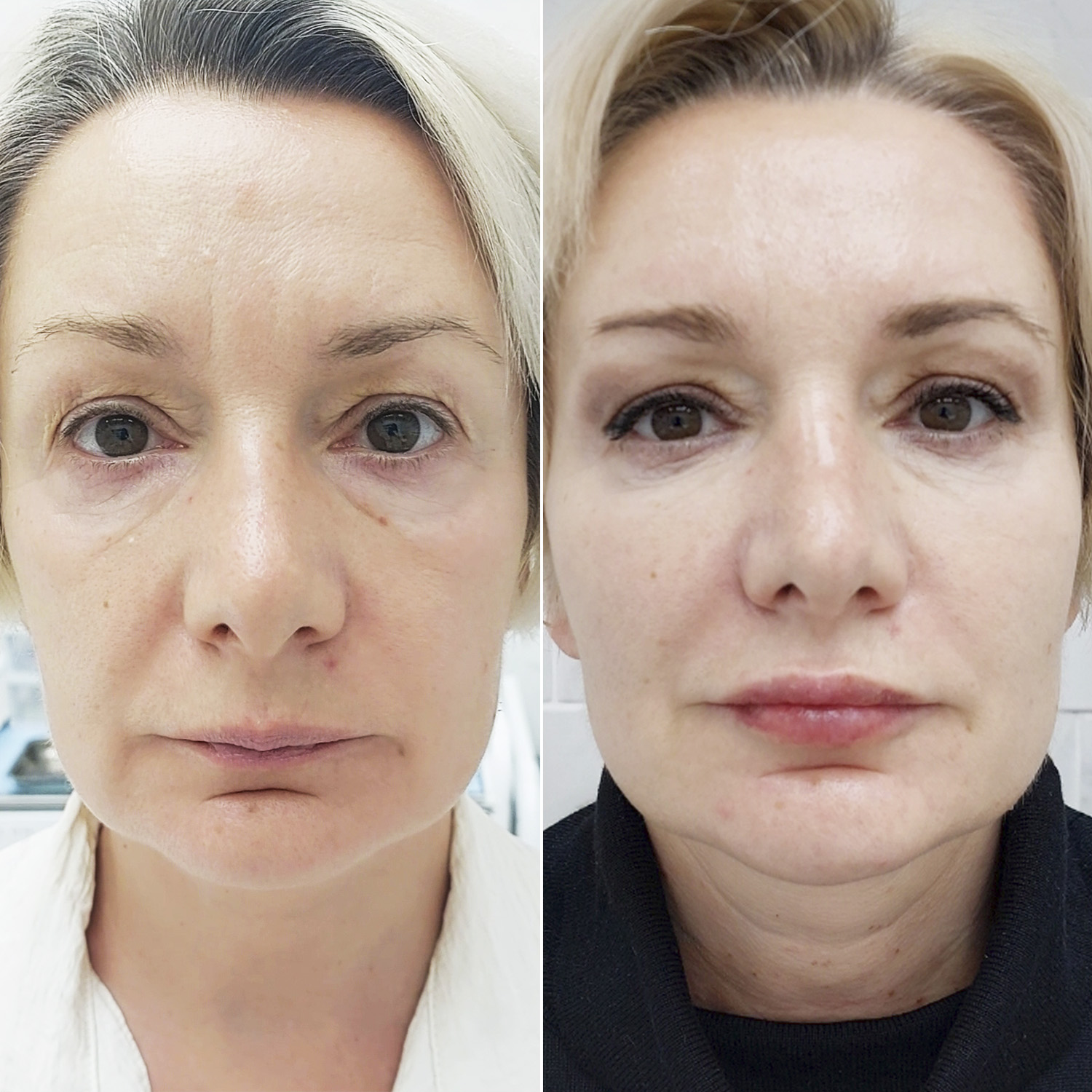 //mechtalina.ru/wp-content/uploads/2020/12/botulinoterapiya-disport-konturnaya-plastika-gub-stilazh-lips-biorevitalizatsiya-litsa-i-glaz-radiess-45-ml-i-stilazh-xl-kolesnikova.jpg