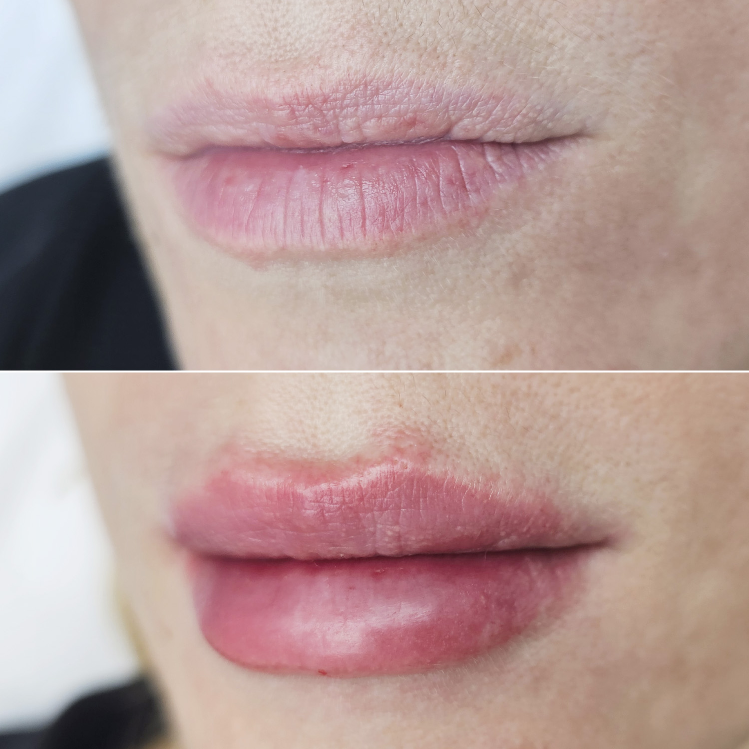 //mechtalina.ru/wp-content/uploads/2020/12/konturnaya-plastika-gub-art-filler-lips-1ml-kolesnikova-2.jpg